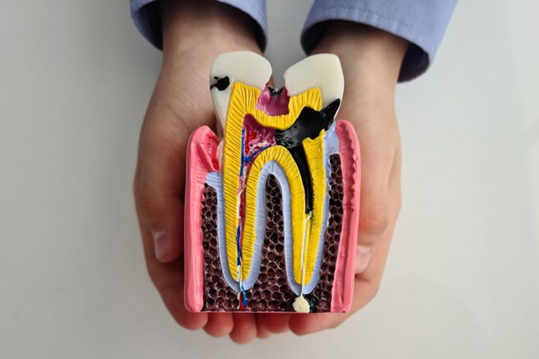 Root Canal Symptoms East Valley Dental Professionals