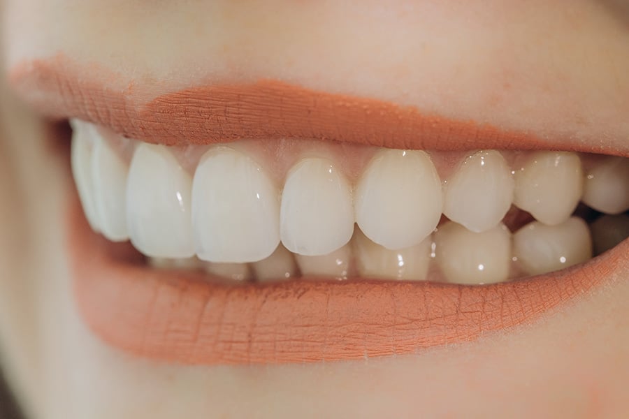 Types of Veneers - Featured Image