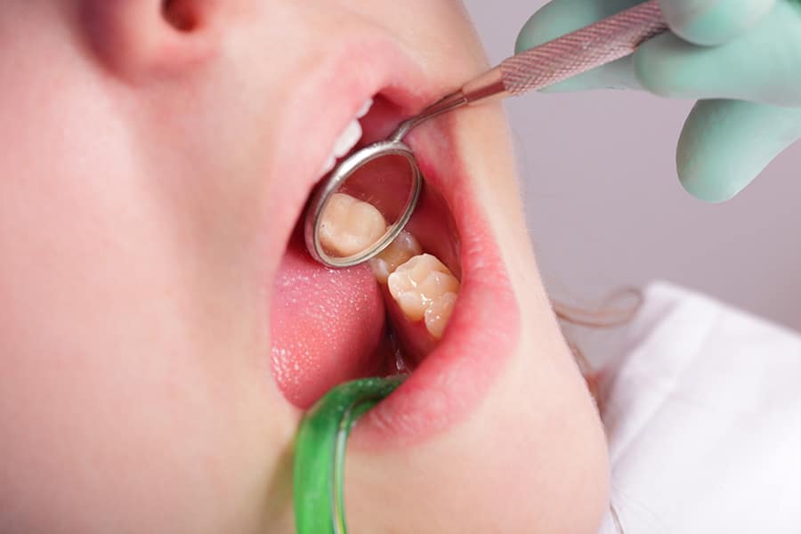 How Long Do Dental Fillings Last - Featured Image