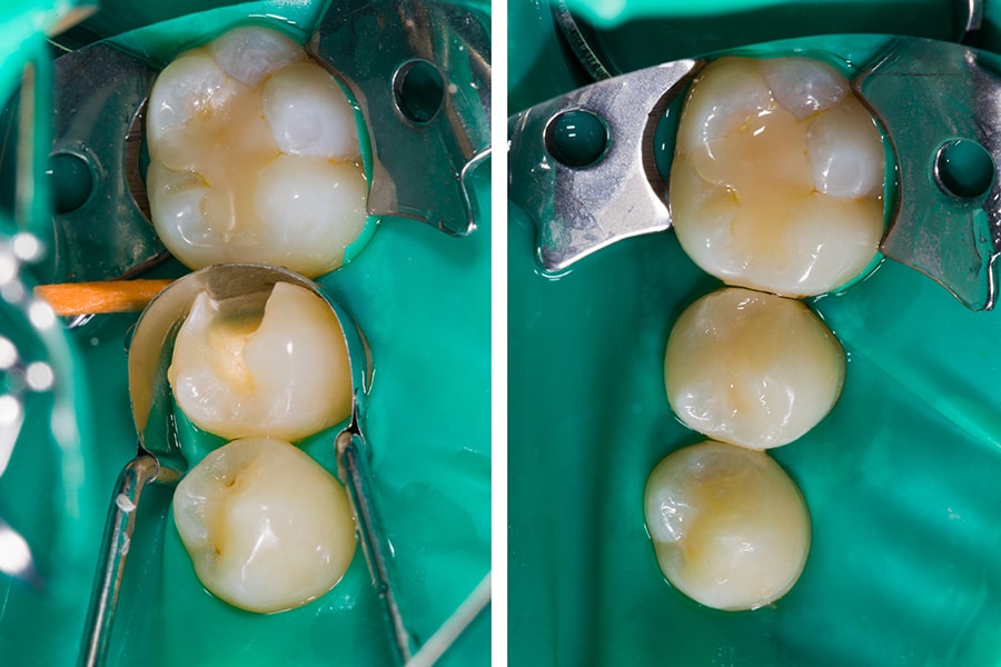 Different types of tooth fillings