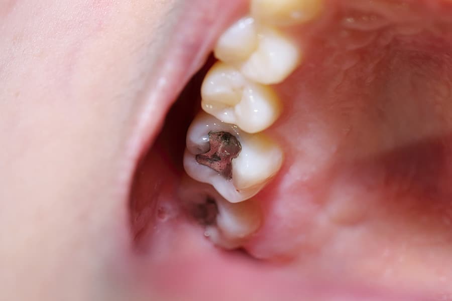 How Long Does a Cavity Filling Take - Featured Image