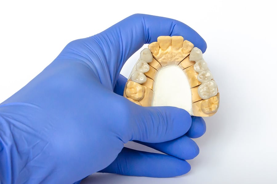 what are dental bridges