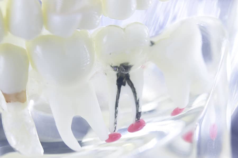 what causes a root canal