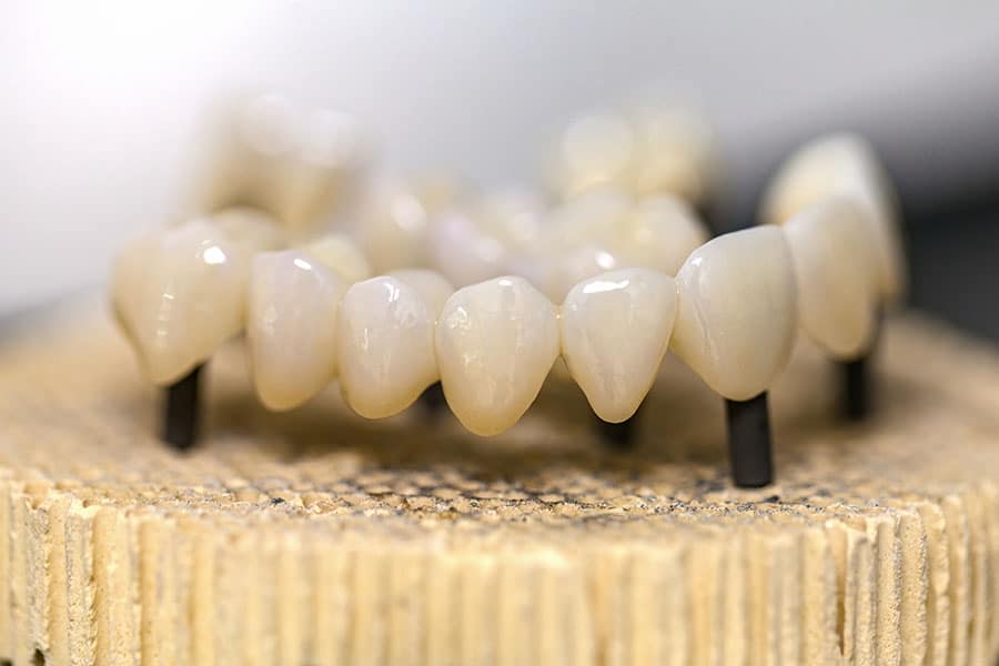 Dental Bridge Procedures: What to Expect from an Experienced Dentist - Featured Image