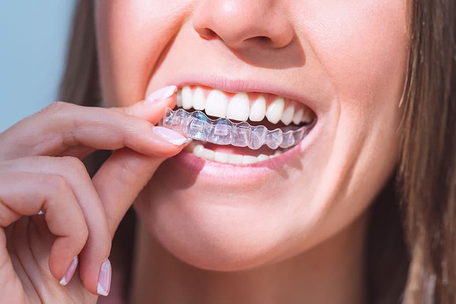 clear correct invisible aligners benefits
