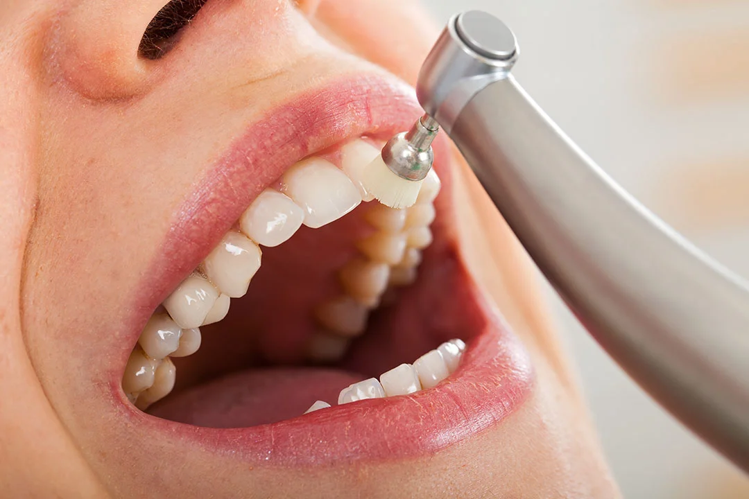 Dental cleanings - Image