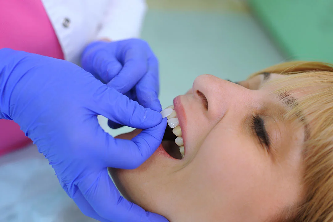 Dental Veneers - Image