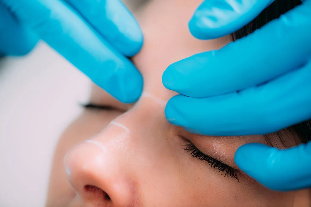 Dermal Fillers - Image
