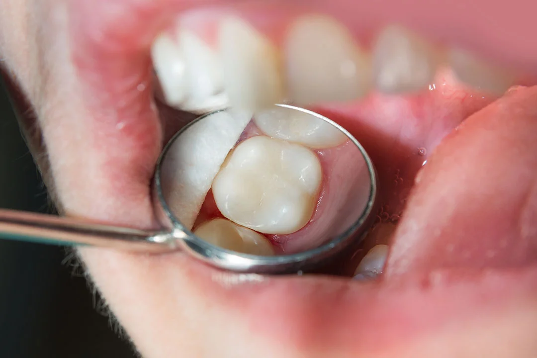 Tooth Cavity Fillings - Image