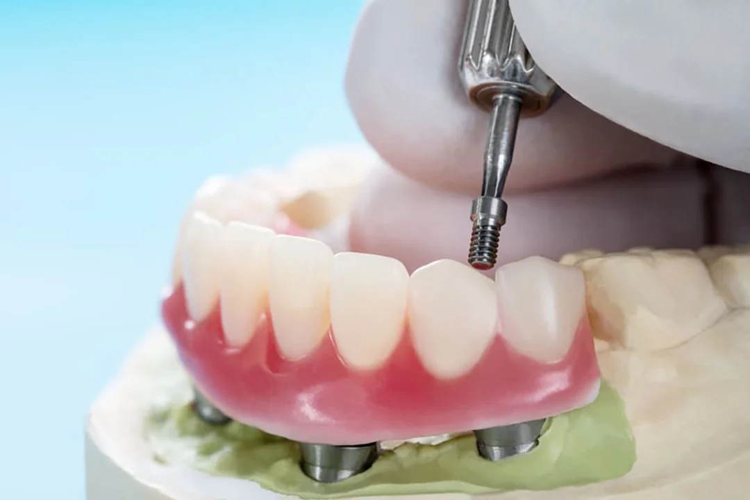 Overdentures - Image