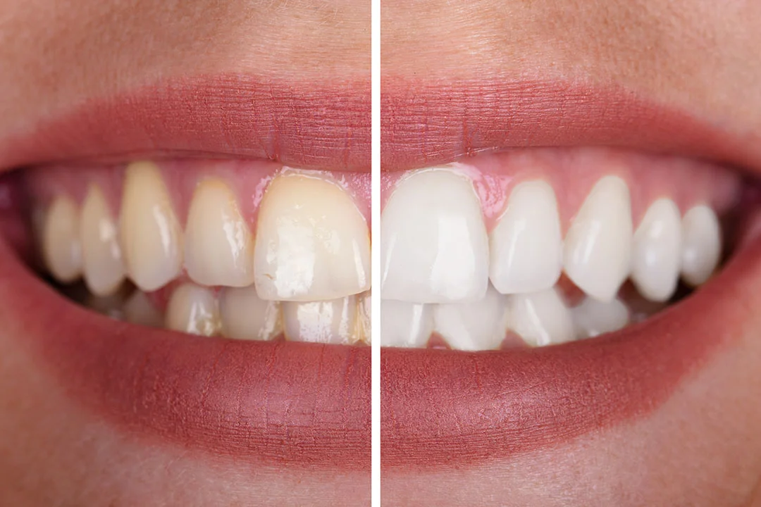 Teeth Whitening - Image