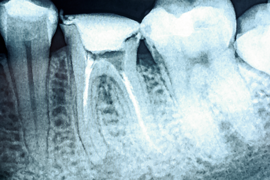 Does Medicare Cover Root Canals? A Comprehensive Guide - Featured Image