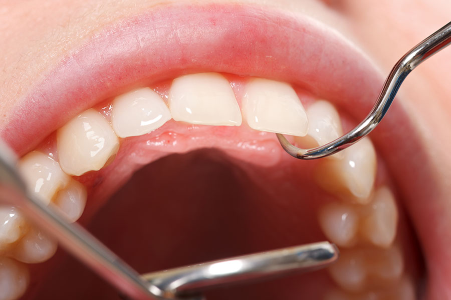 Dental Bridges vs. Tooth Implants - Featured Image