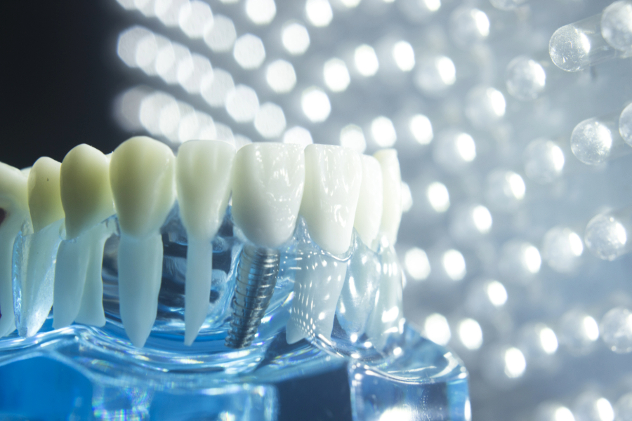 Are Dental Implants Covered by Insurance? - Featured Image
