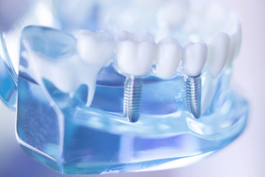 full mouth dental implants more affordable