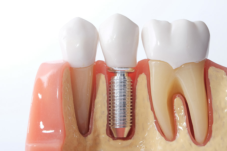 The Dental Implant Process: What Dobson Ranch Patients Can Expect (From Consultation to Recovery) - Featured Image