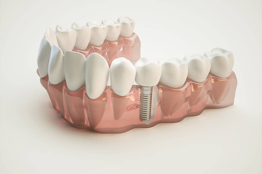 Why East Valley's Families Trust EVDP for Dental Implants: A Relaxed, One-Office Experience from Consultation to Care - Featured Image