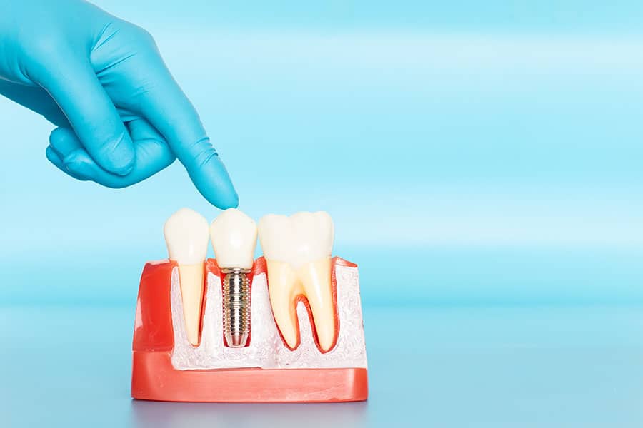 Medicare Doesn't Cover Dental Implants in Arizona? Here's What Mesa Seniors Need to Know (2025 Guide) - Featured Image