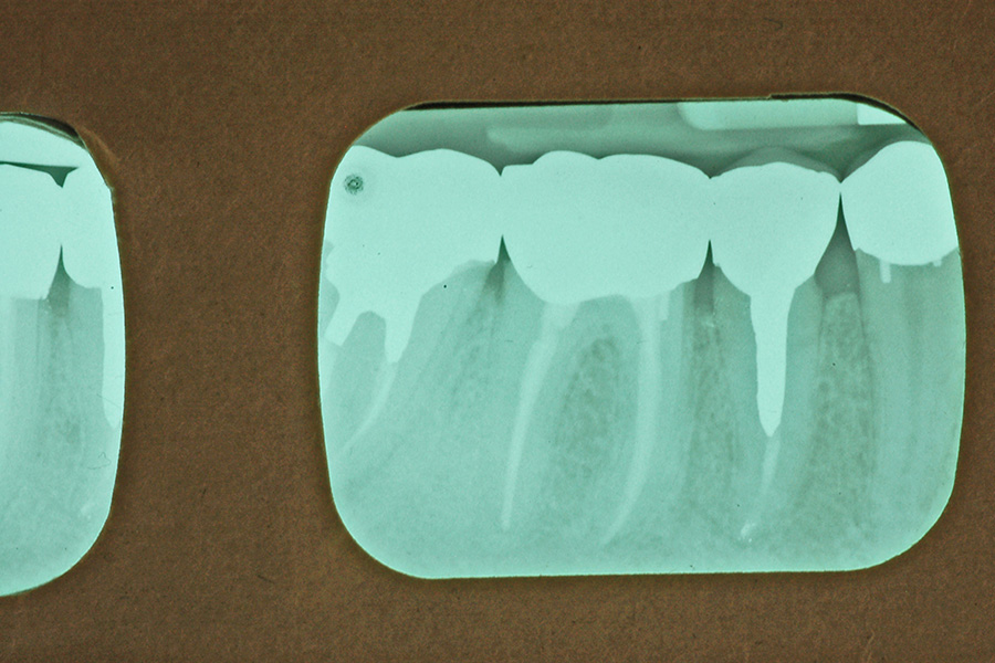 The Real Value of Root Canals and Crowns for Mesa Patients: Saving Your Natural Teeth Is Worth the Investment - Featured Image