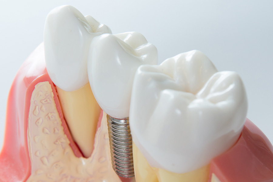 Why Implant-Supported Restorations Are the Smartest Long-Term Choice After Tooth Loss implant-supported restorations
