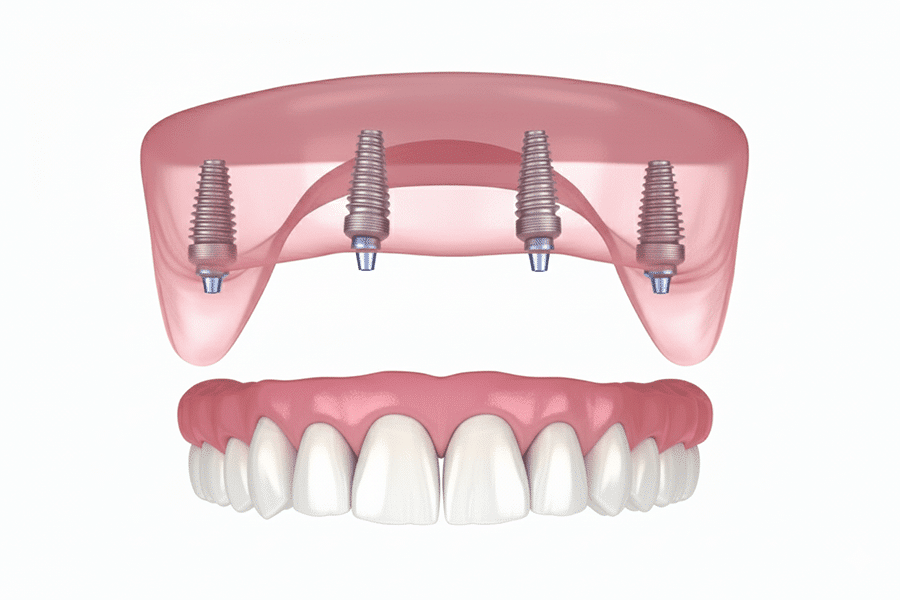 all on 4 dental implants