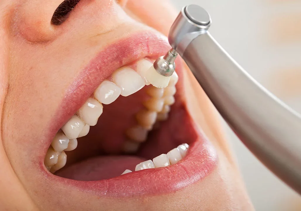 Dental Cleaning