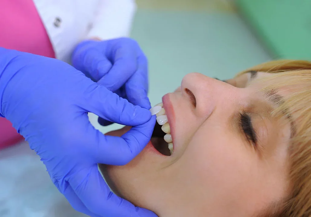 Dental Veneers