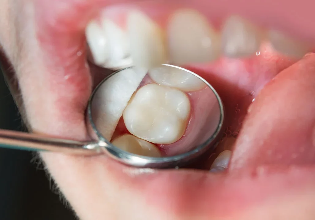 teeth Fillings