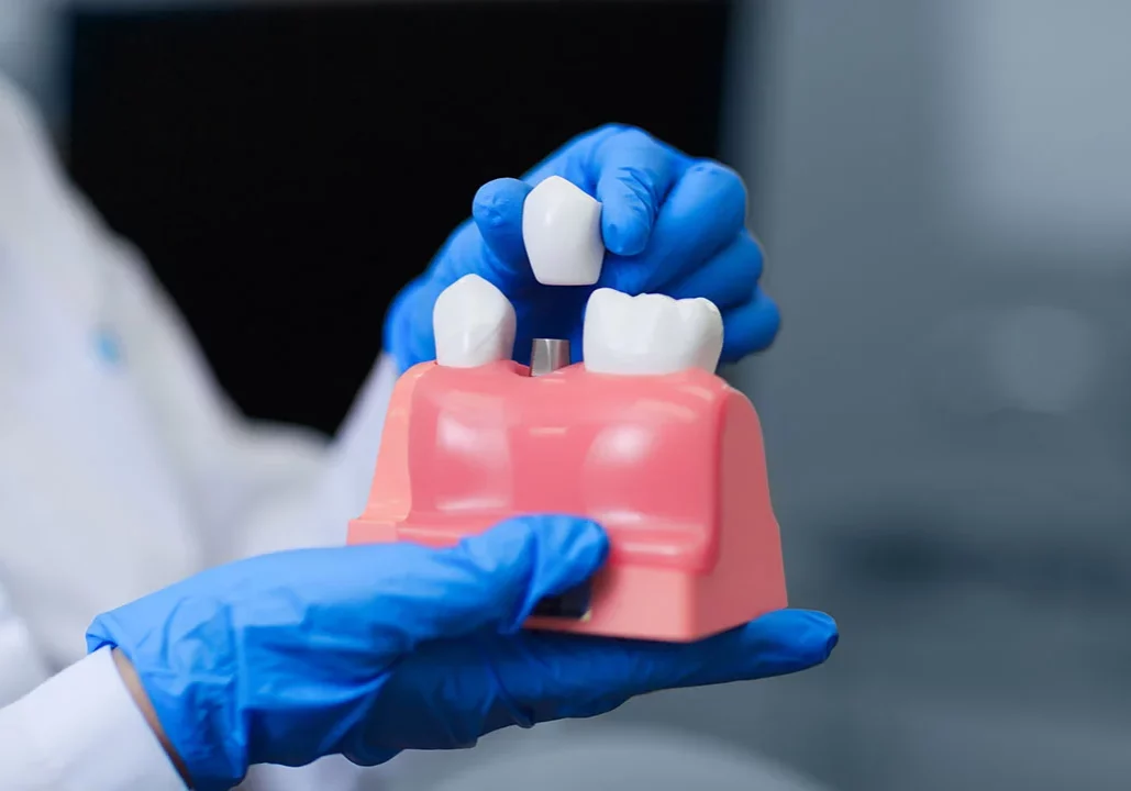 dental implants