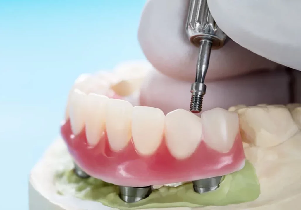 Overdentures