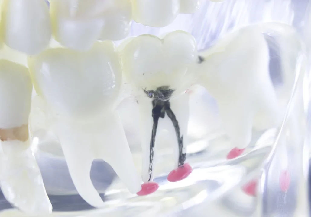 Root Canals