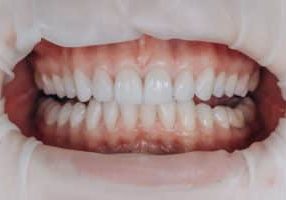 dental crowns on front teeth