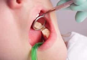 how long do dental fillings last
